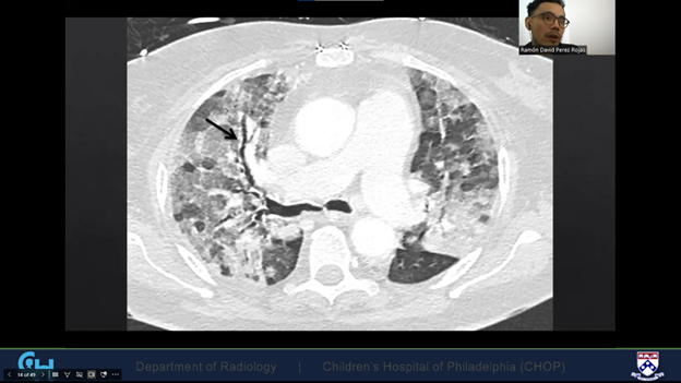 Dengue  Diffuse Alveolar Hemorrhage